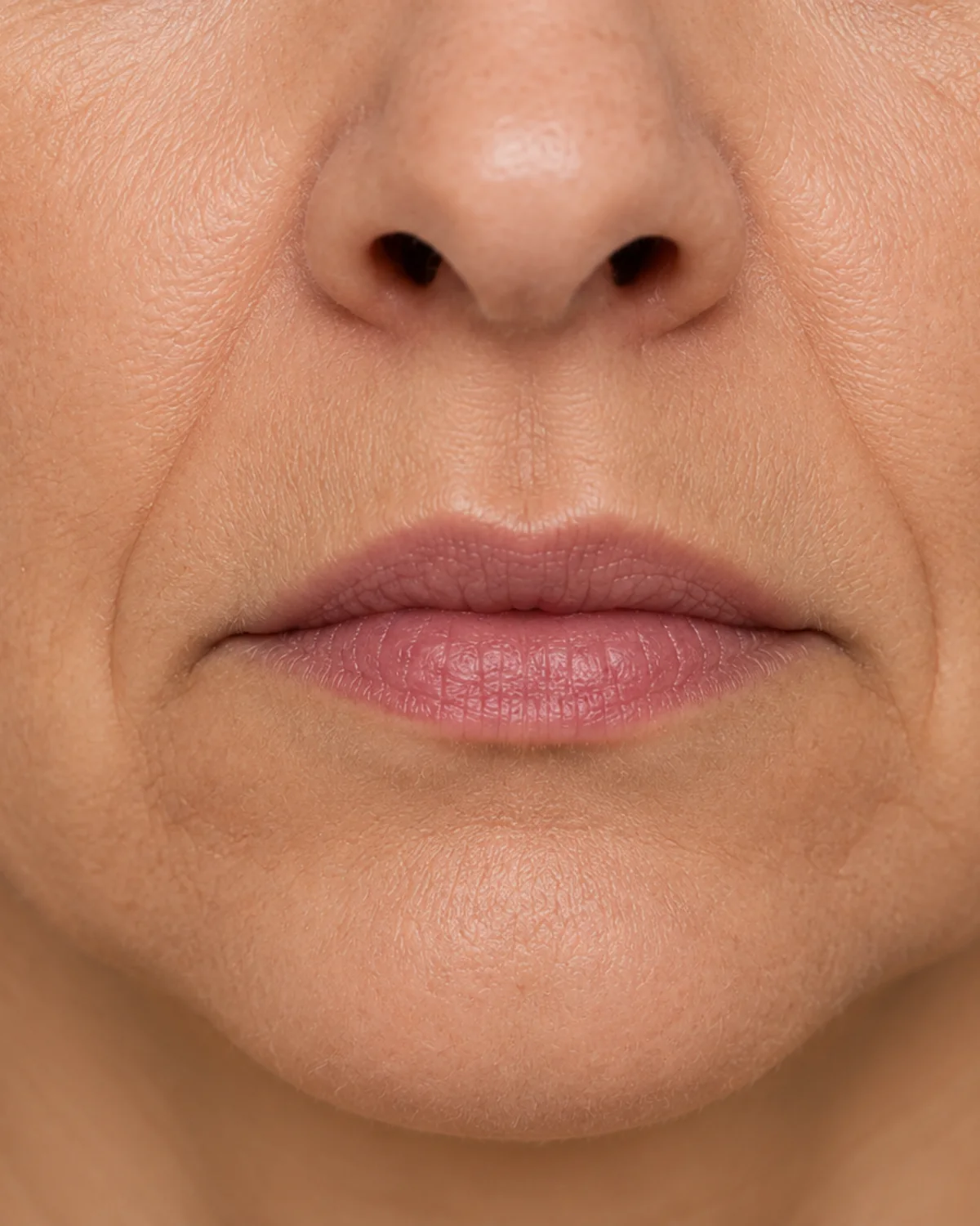 Nasolabial Folds