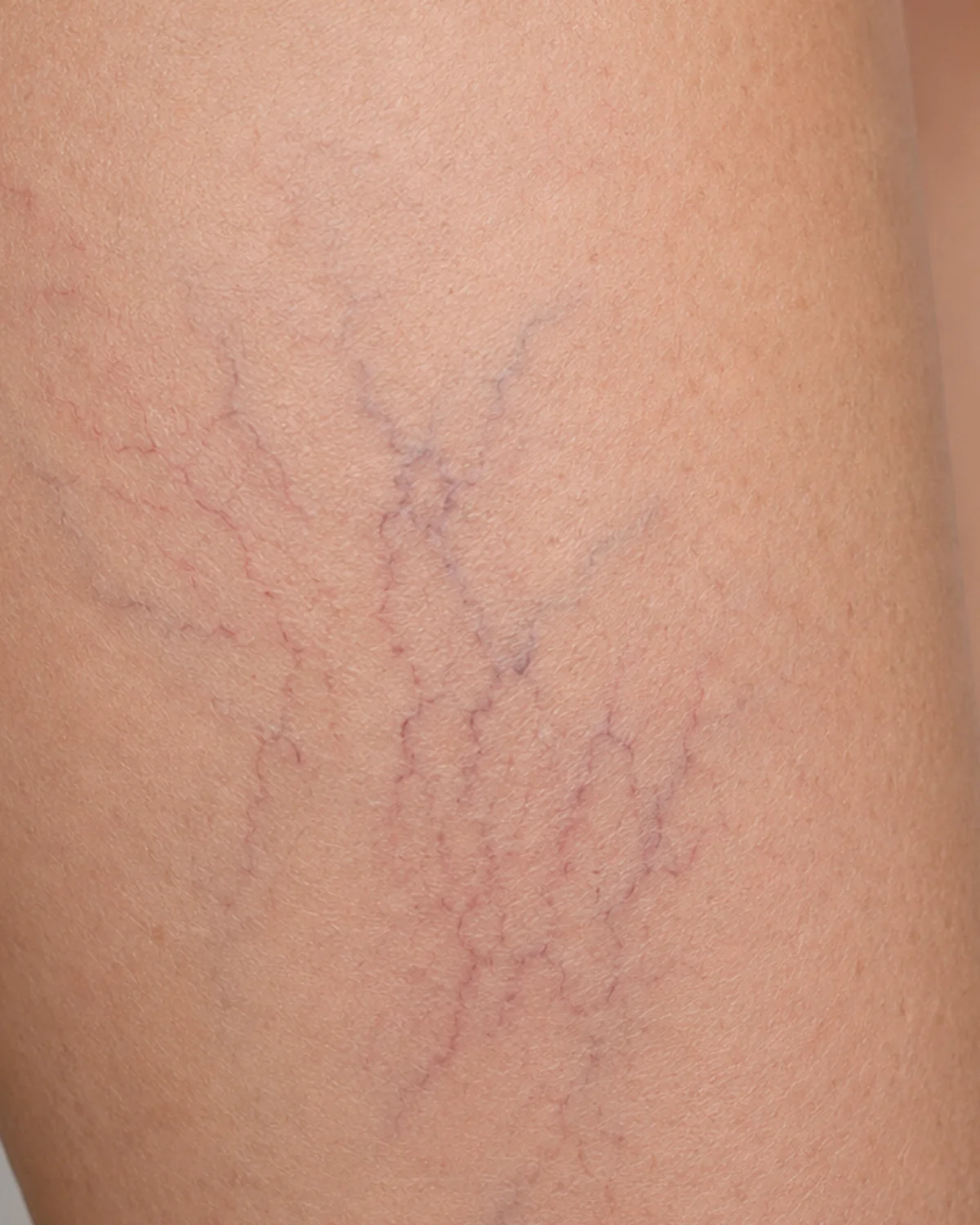 Spider Veins