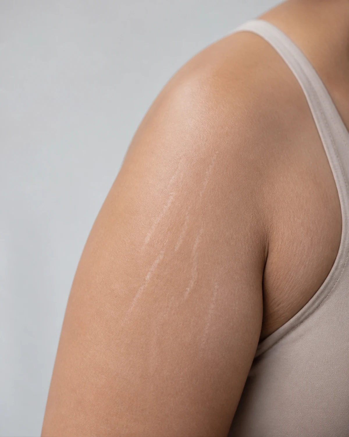 Stretch Marks