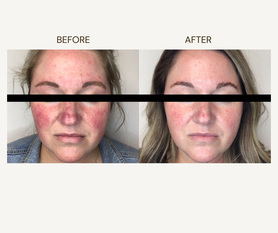 IPL before and after treatment result at 816 Med Spa