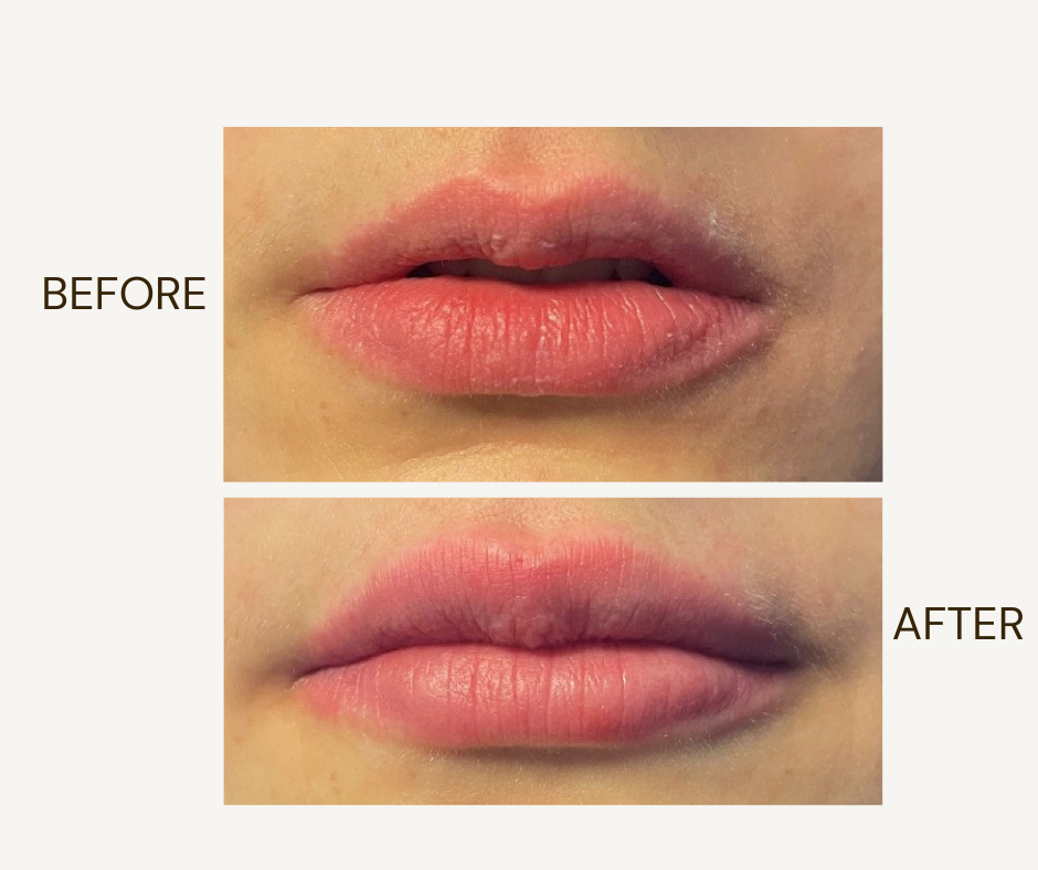 Lip filler before and after treatment result at 816 Med Spa