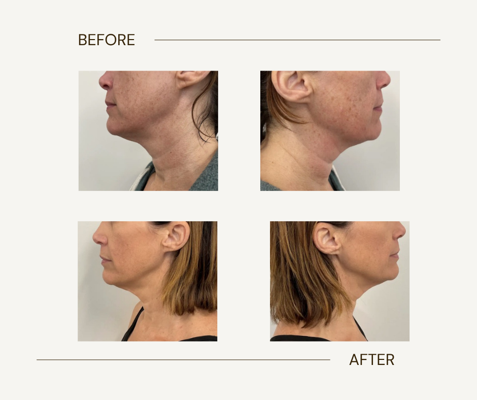 Radiofrequency microneedling before and after treatment result at 816 Med Spa