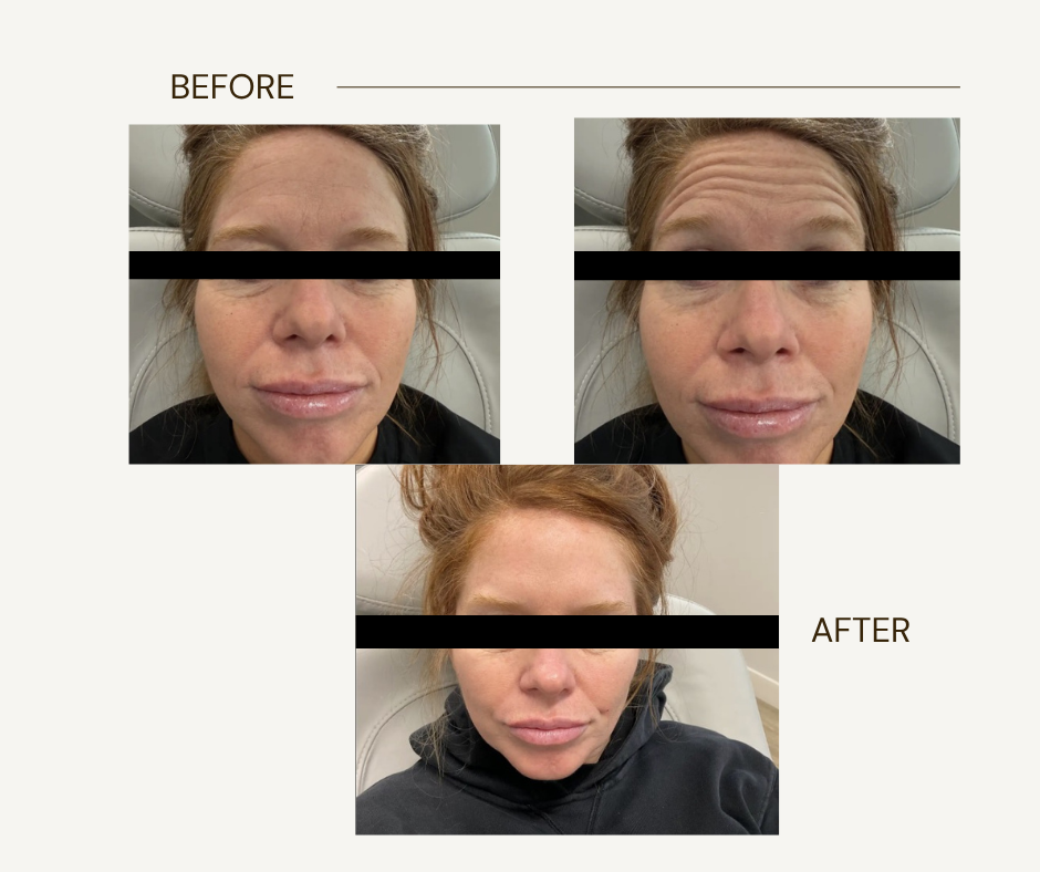 Xeomin before and after treatment result at 816 Med Spa