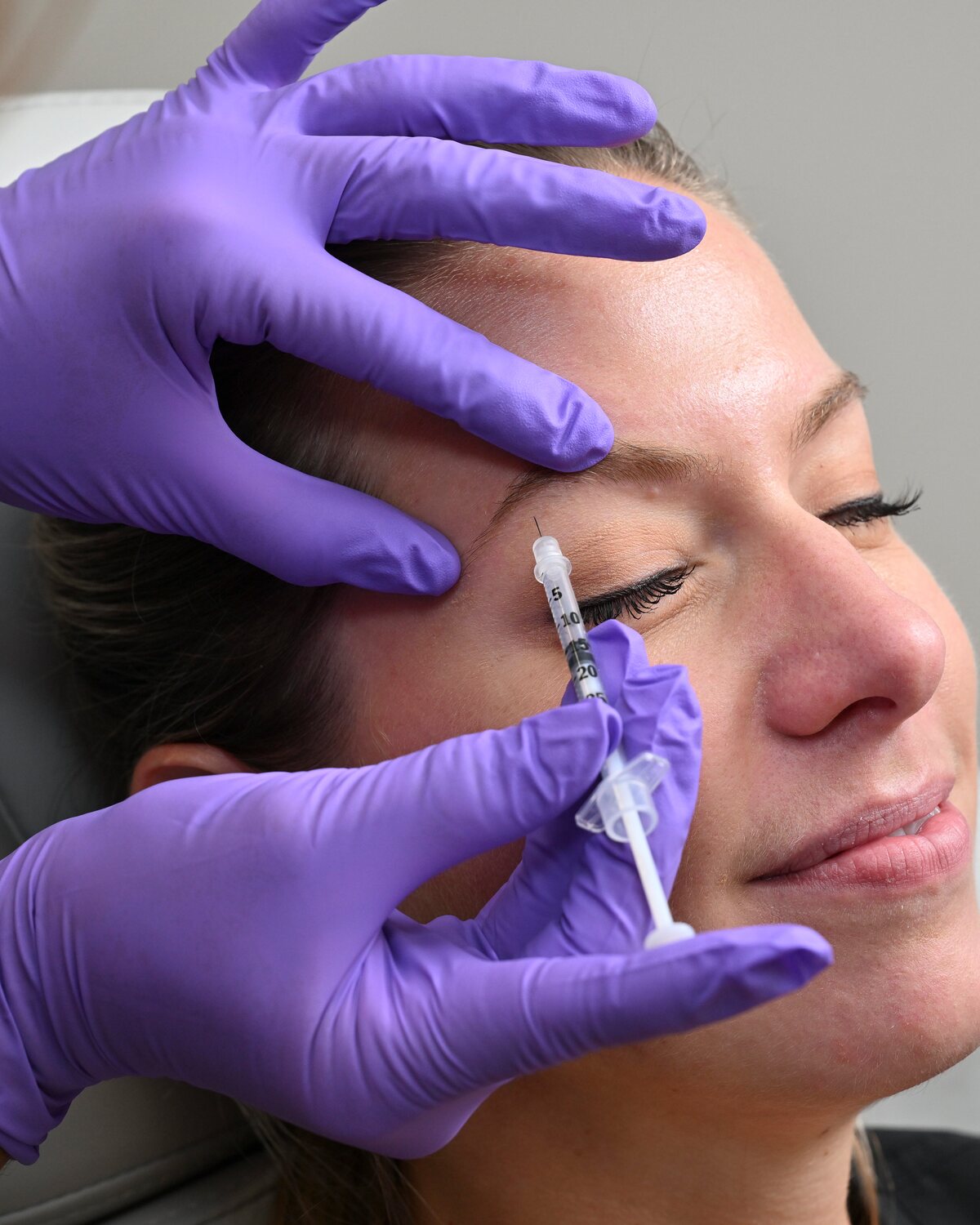 Brow Lift