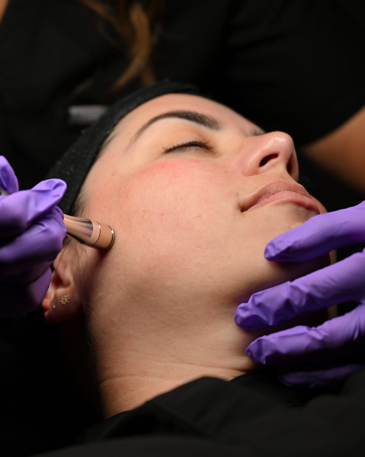 Microdermabrasion Facial